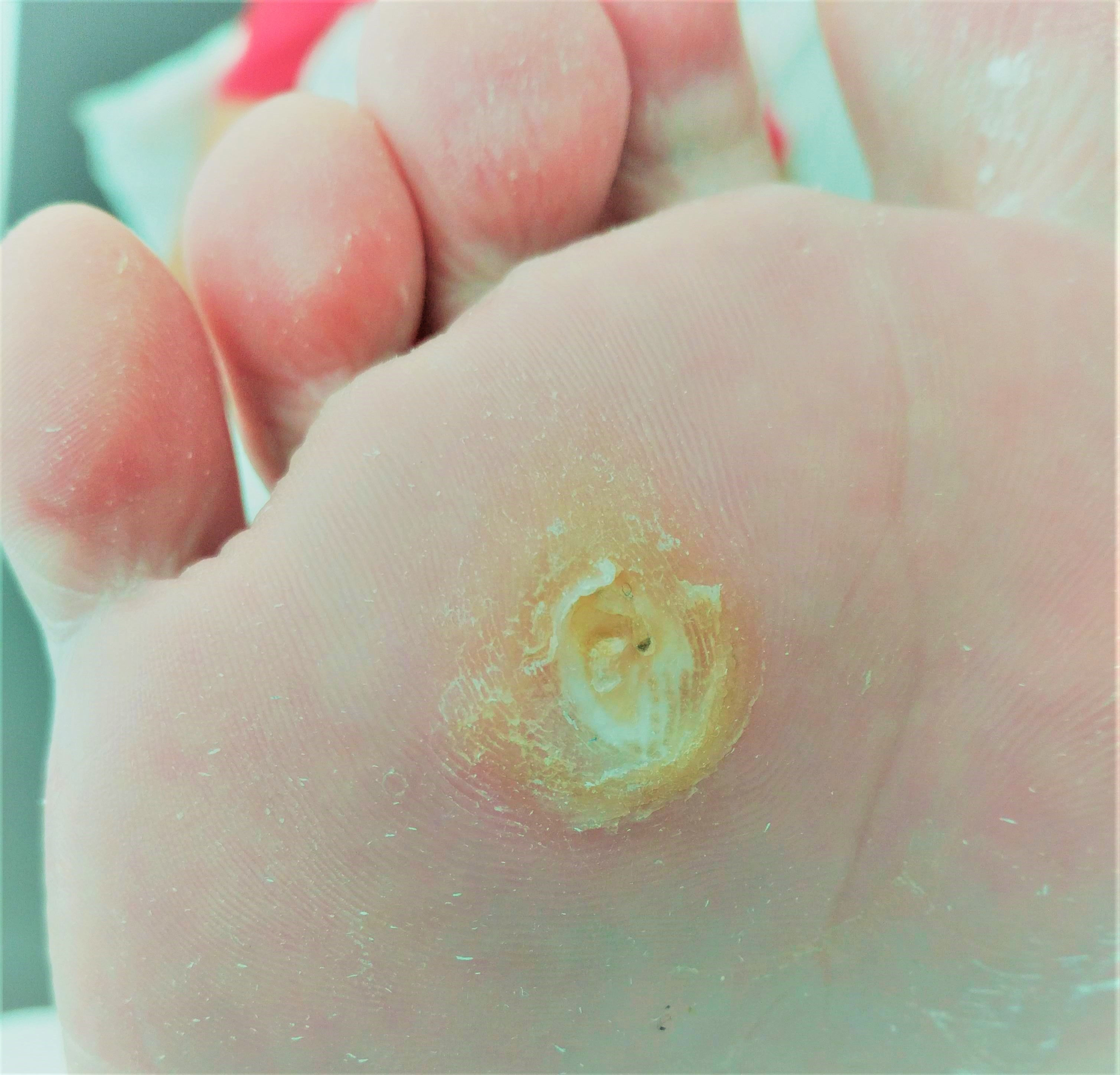 Eksteroog, eeltpit, likdoorn